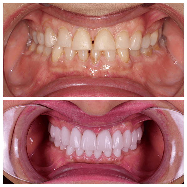 Cali Dental Arts Before and After Photo
