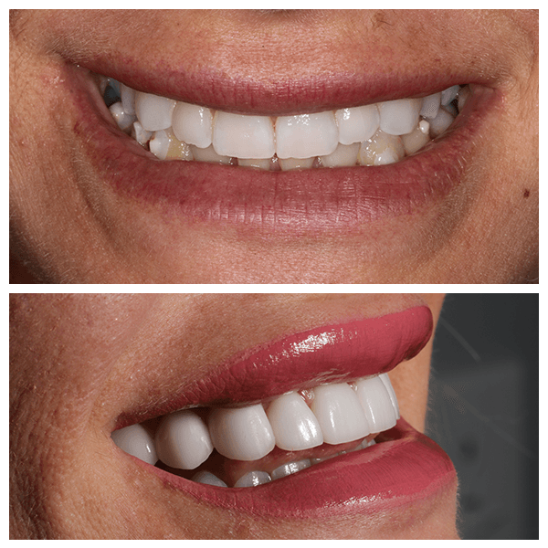 Cali Dental Arts Before and After Photo