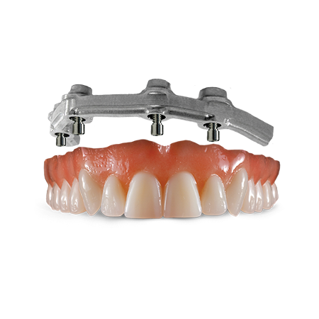 Implant Supported Removable