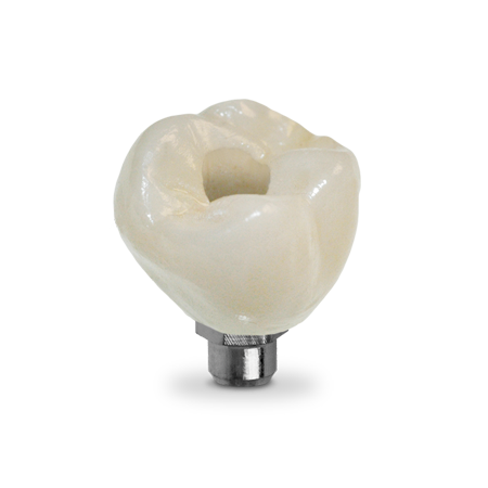 Screw-Retained Crown